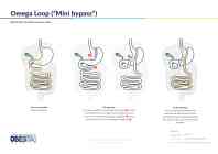 Gastric Bypass - Omega Loop Of Mini-Bypass - Overzicht